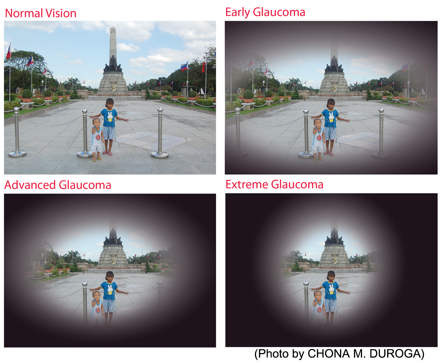 Image showing how a person would perceive glaucoma at various stages